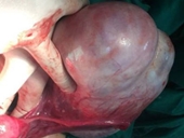 Xử trí thành công khối u nhầy buồng trứng nặng 1,8kg