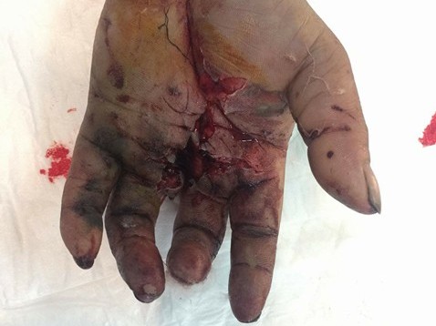 Vỡ toác tay vì pin dự phòng phát nổ