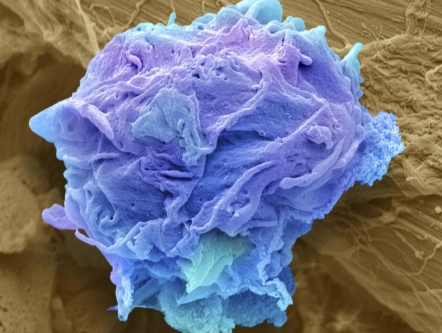 Cứ 3 người Singapore thì có một bị ung thư