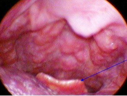 Suýt tử vong vì viêm nắp đường thở sau hóc xương 20 ngày