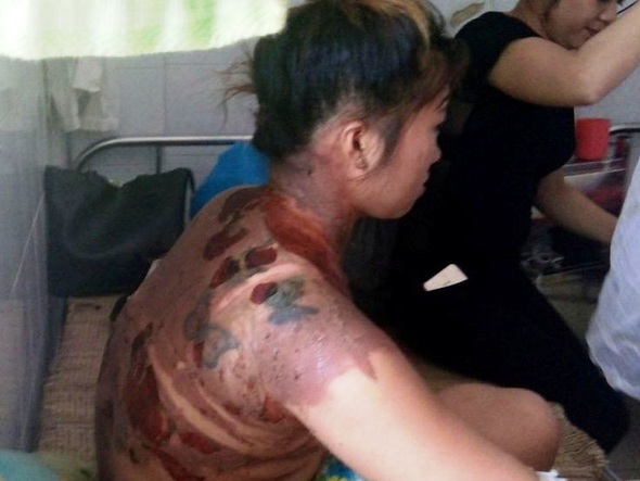 Chồng cầm ấm nước sôi đổ lên người vợ