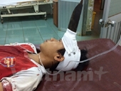 Đắk Nông Cứu sống bé trai 12 tuổi bị dao phay đâm giữa trán