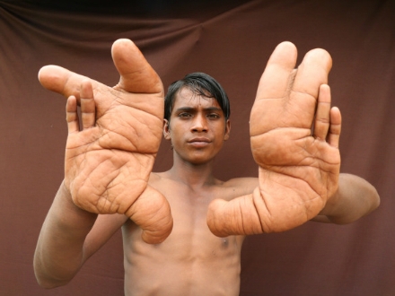 Bàn tay khổng lồ của cậu bé khiến y học bó tay