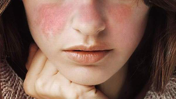 Lupus là vấn đề toàn cầu, với hàng triệu người mới mắc hàng năm trên thế giới nhưng xã hội còn ít biết đến sự tồn tại của nó. Hình minh họa. Nguồn: Internet.