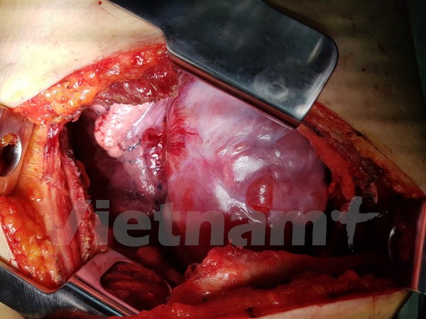 Đà Nẵng Cứu sống một bệnh nhân bị khối u lớn chèn ép tim phổi